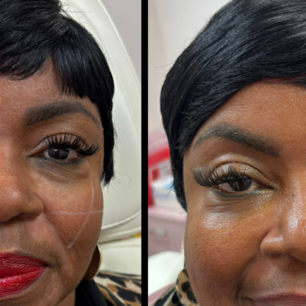 Filler To tear Trough (under Eye)