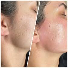 Face Cheek Wax
