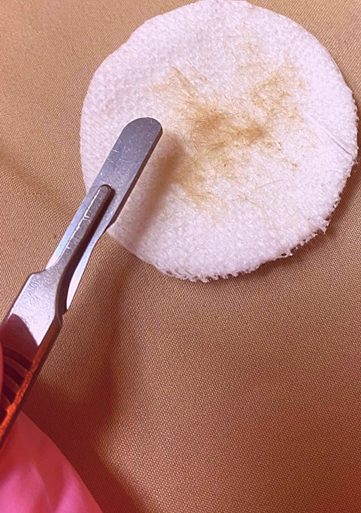 Dermaplaning