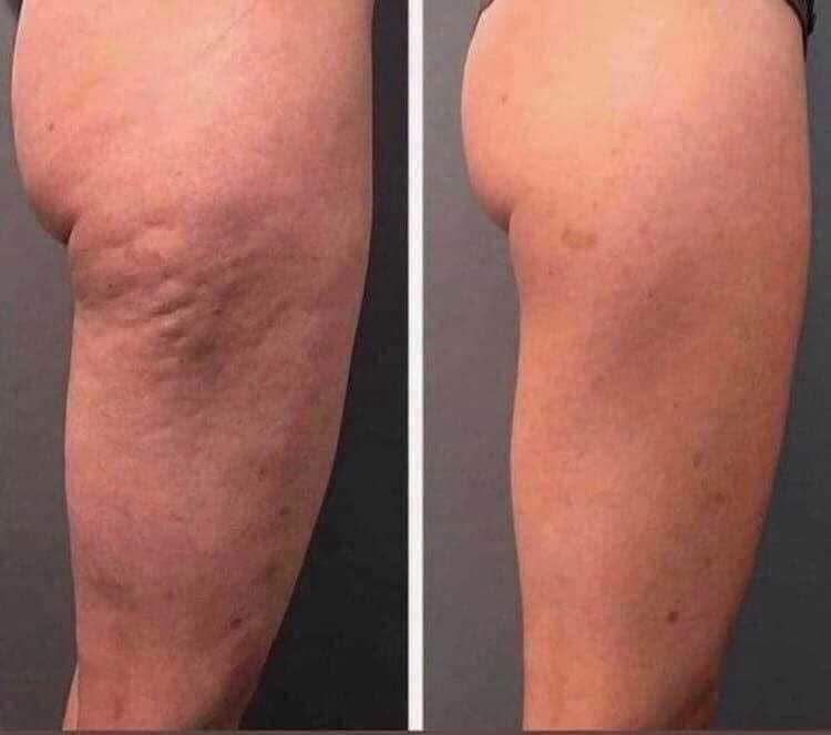 Body Contouring Treatment