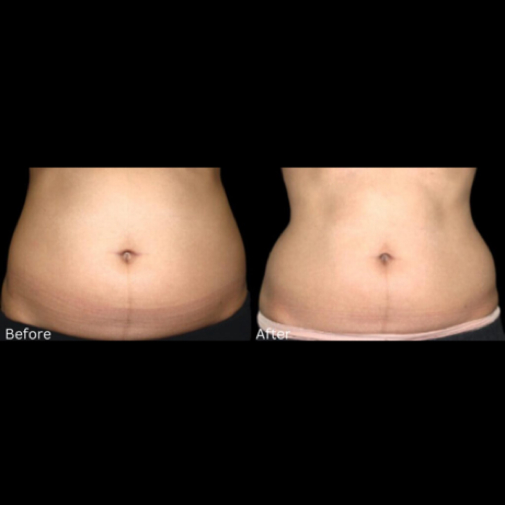Fat Dissolving Mesotherapy Large at Unique’sbeautybar in Oswego, IL