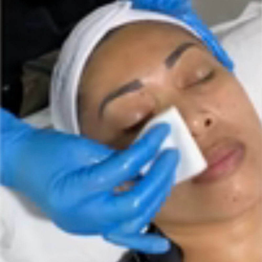 Chemical Peel at Holistic Skin Center in Edgewater, FL