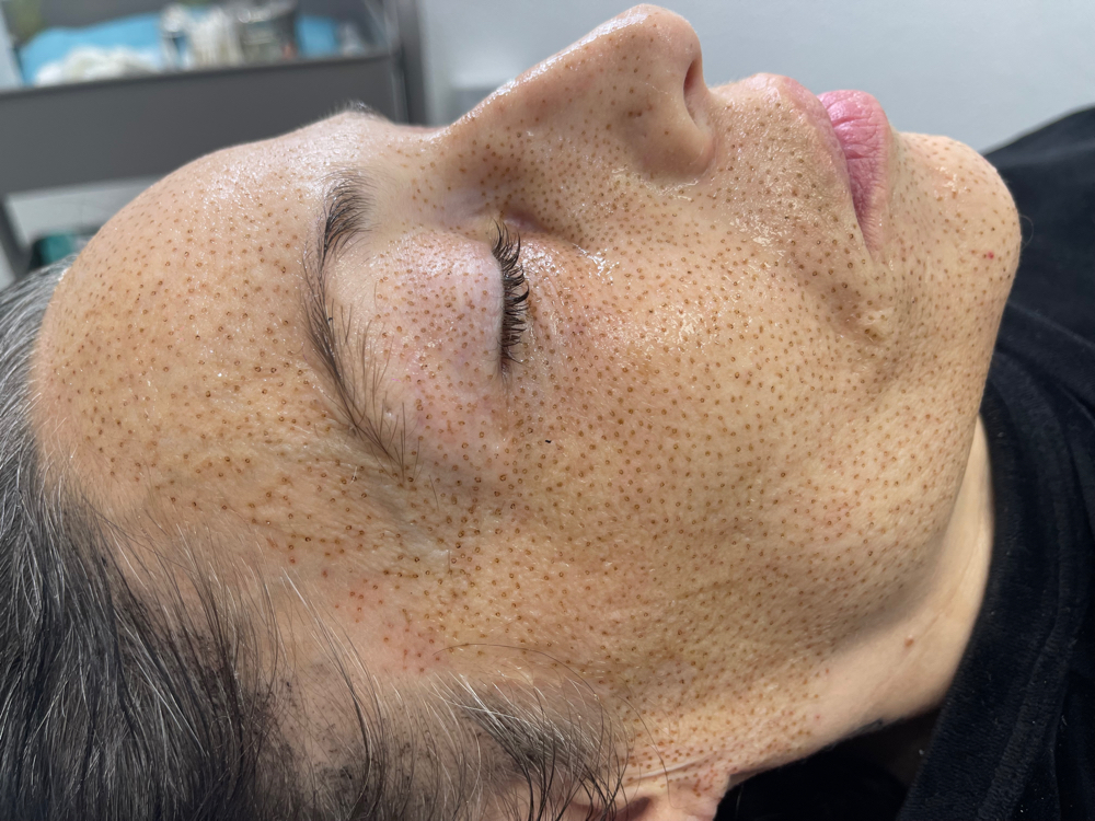 Full Face Rejuvenation By Plasma