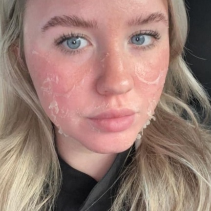 Chemical Peel at Corrective treatments + professional skincare in Atlanta, GA