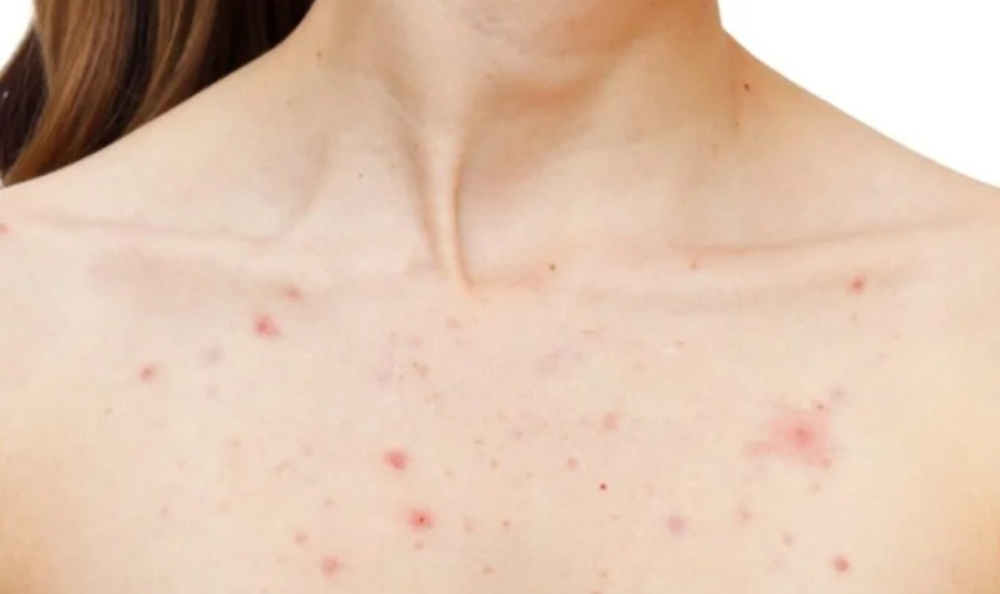 Chest Facial