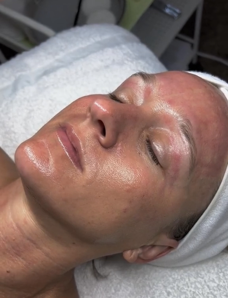 Nano Needling Facial