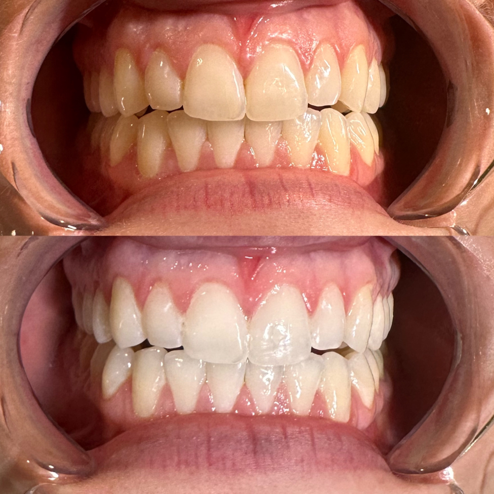 Teeth Whitening