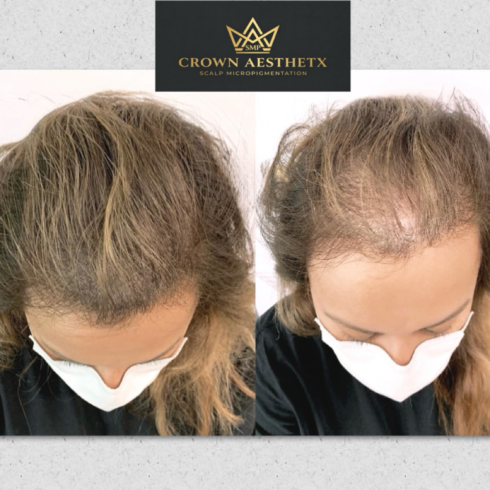 Female SMP Density at Crown Aesthetx in Modesto, CA