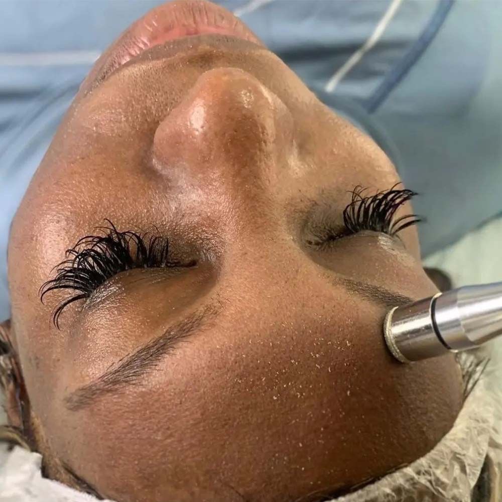 Microdermabrasion Facial