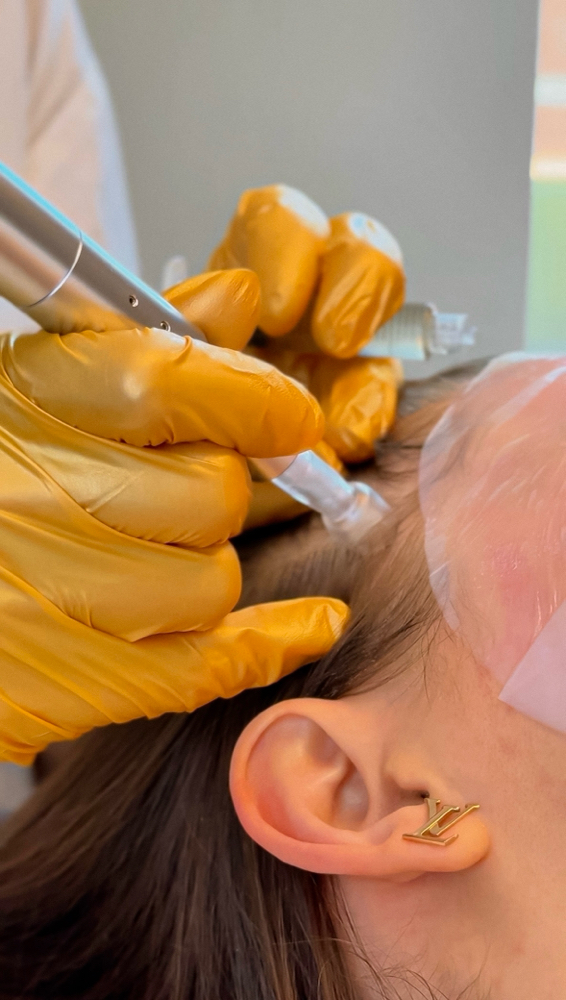 Toskani Scalp Microneedling x5 at Skinfinity in Chicago, IL