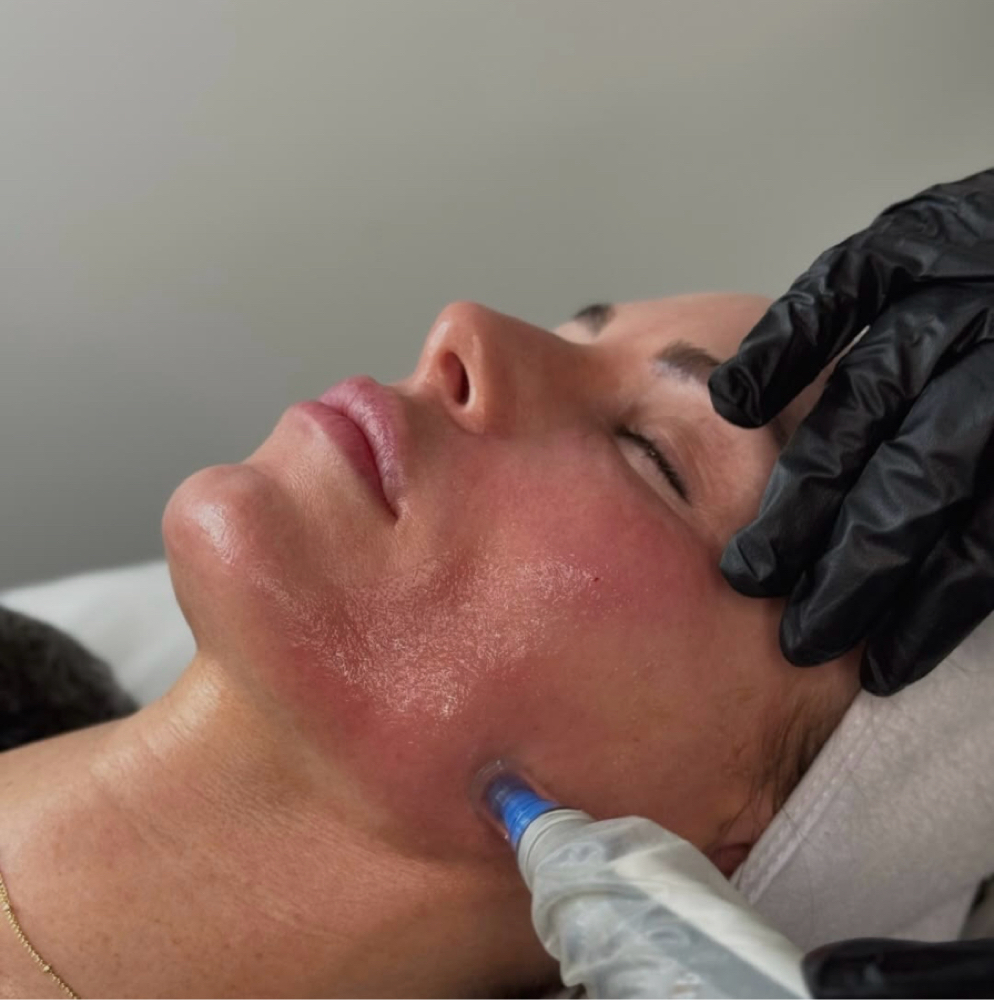 Microneedling at Studio Lux Beauty Bar    Esthetics by Delanie & Lindsey in Mineola, TX