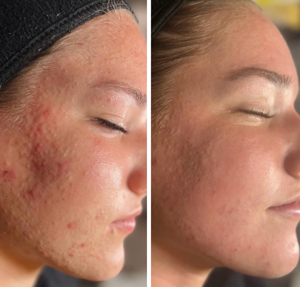 Acne Boot Camp Program