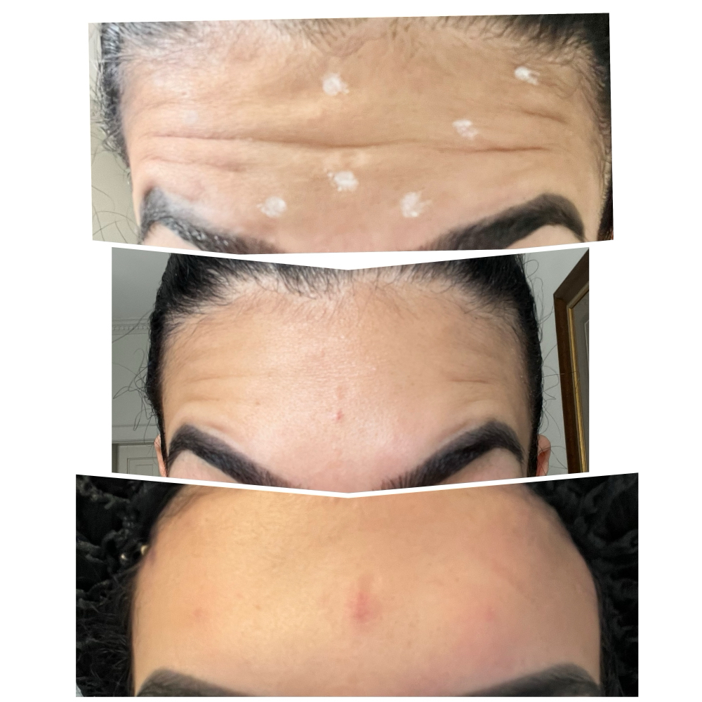 Botox