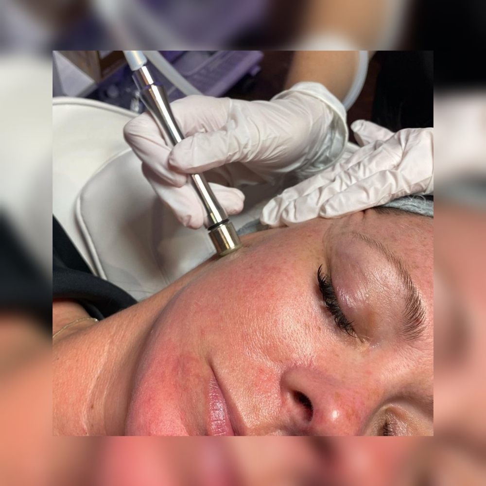 Microdermabrasion Facial