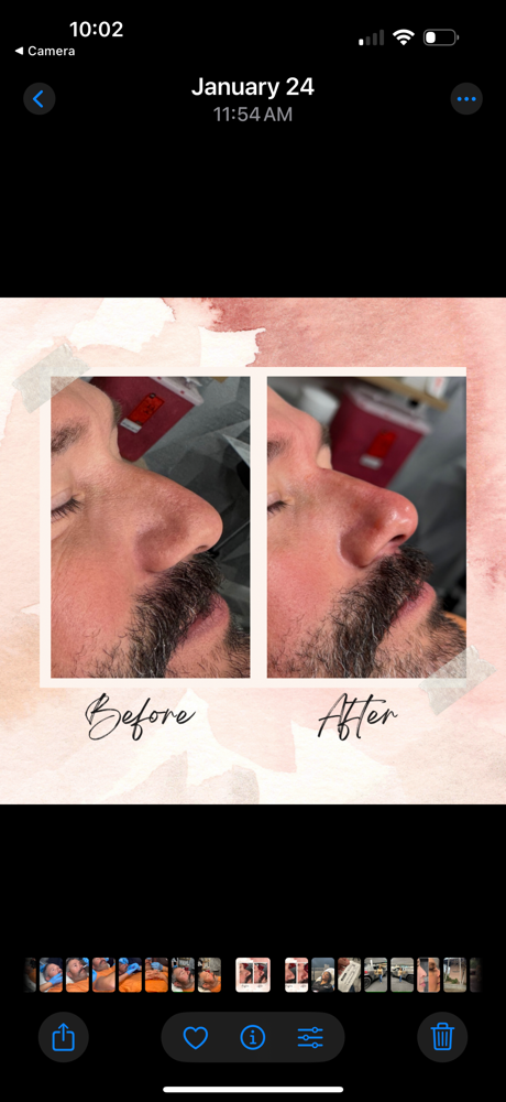 Non Surgical Filler Rhinoplasty