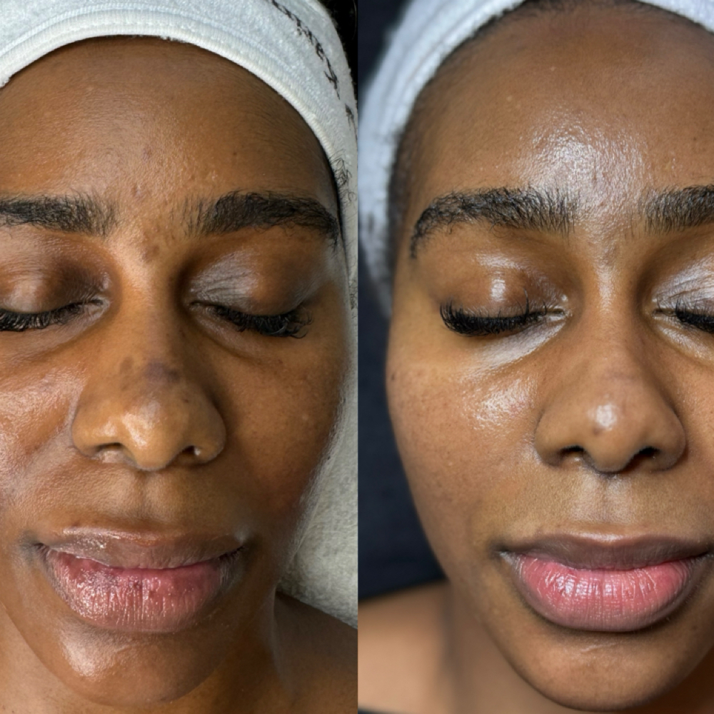 Pigment Correct Peel Package 2 at Oasiah Aesthetics in New York, NY