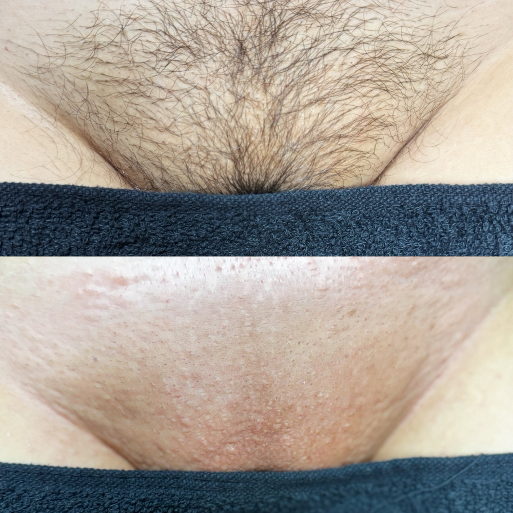 Brazilian Wax