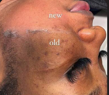 Dermaplan & MicrodermabrasionFacial