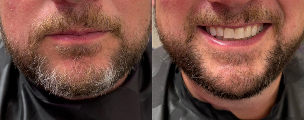 Beard Coloring