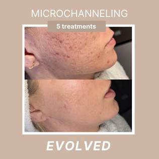 Microchannel