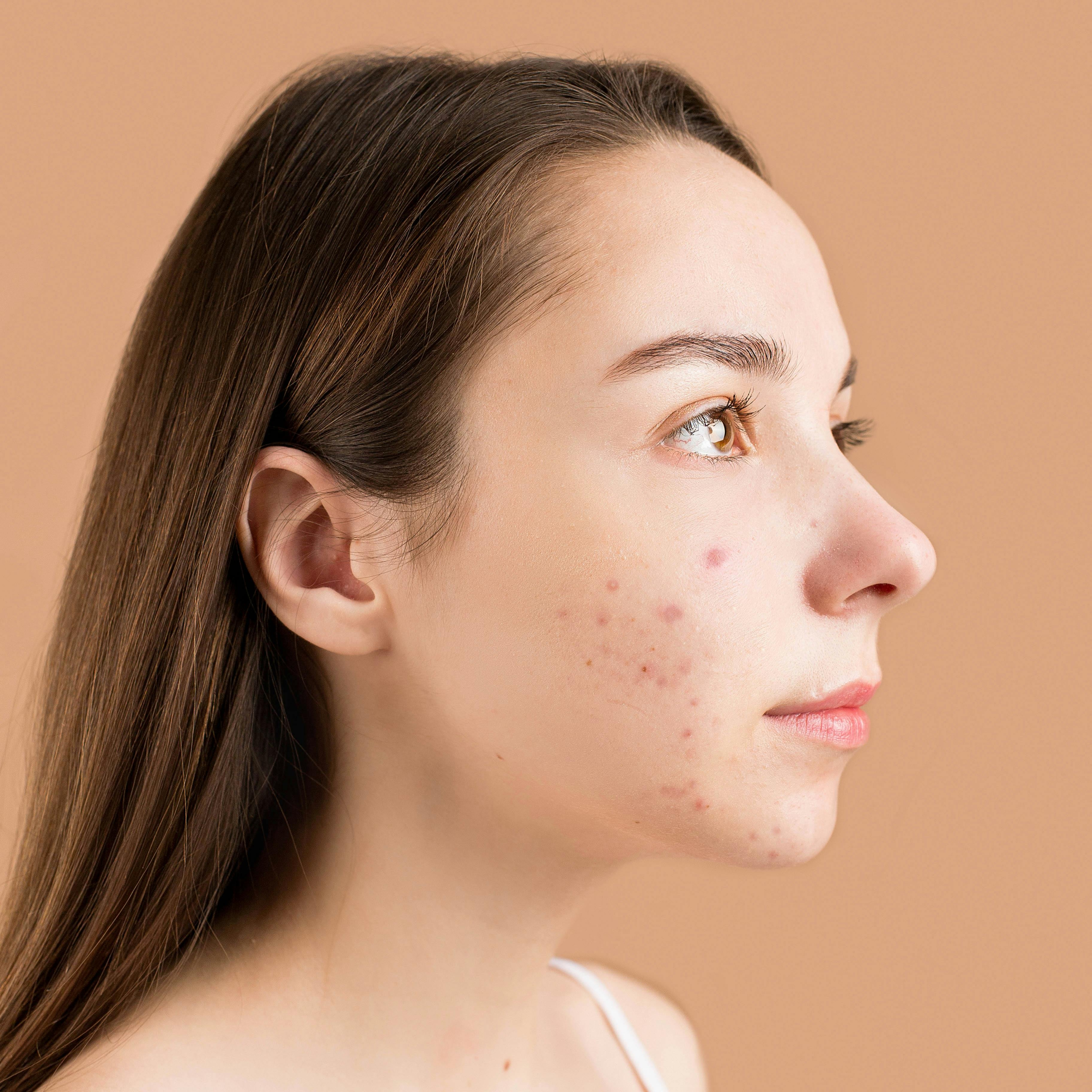 Teen - Custom Consult at Blue Ridge Skin in staunton, VA