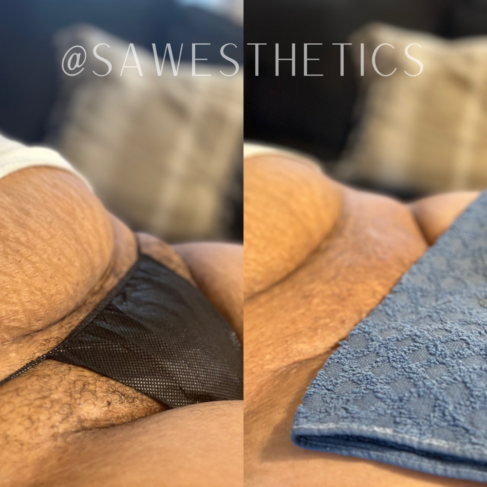 Brazilian👙 at Skyn A’Waites Esthetics in Raleigh, NC