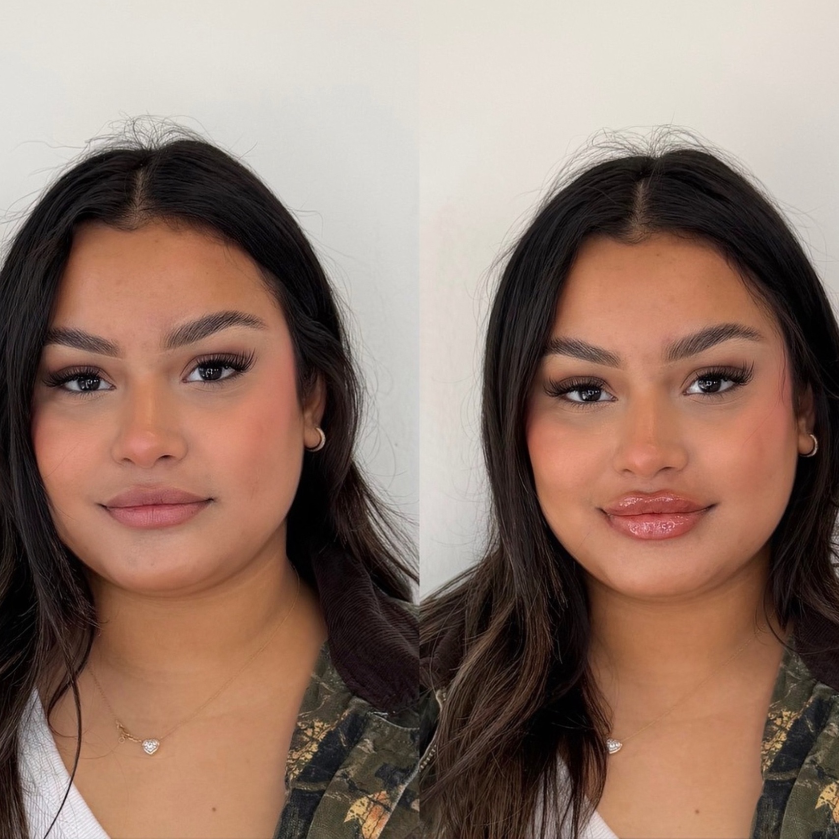 RUSSIAN LIP - FILLER