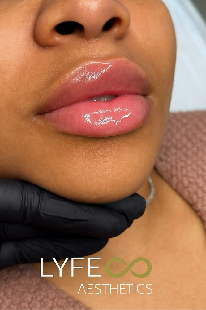 Lip Filler