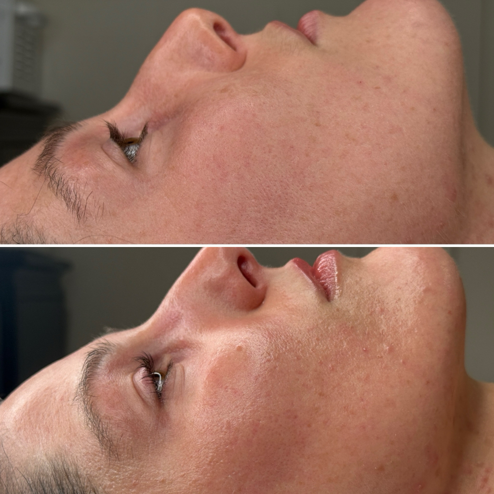 Basic Dermaplaning Facial at Illuminate Lashes and Beauty in Trussville, AL