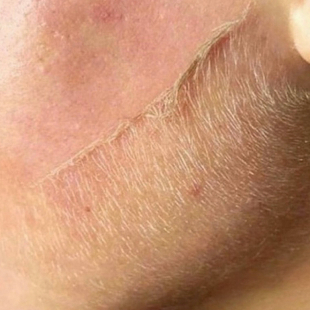 Dermaplane Add-On at Suntoucher Skinworks in Wilmington, NC
