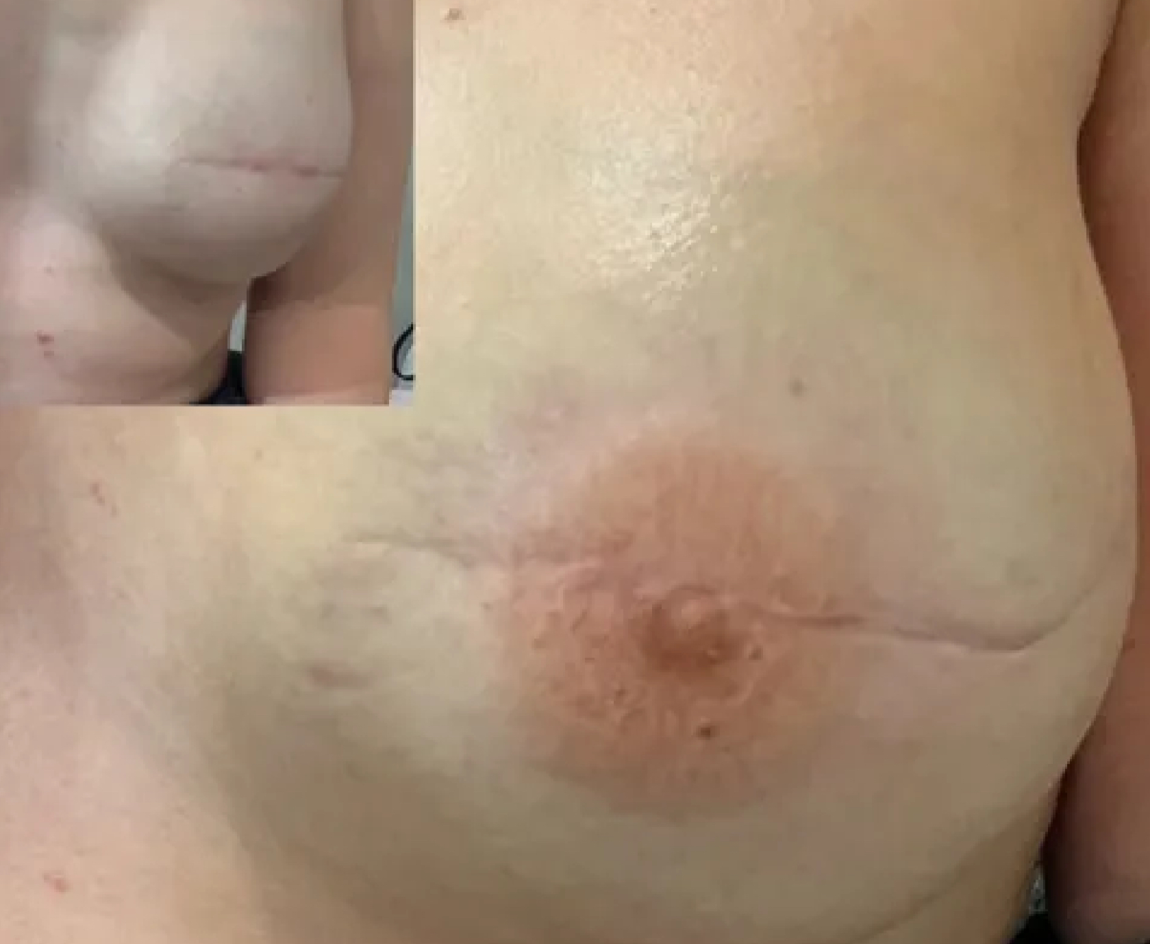 3D Areola Tattooing
