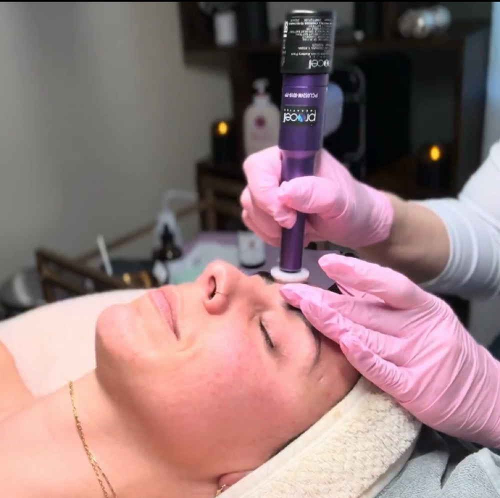 ProCell Microchanneling at The Skin Bungalow Aesthetic Studio in Arvada, CO