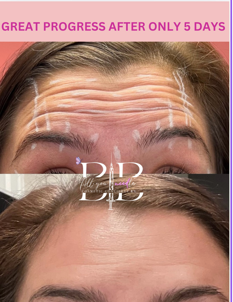 Neurotoxin ( Botox ) at AllyouneedlexBB in Grand Praire, TX