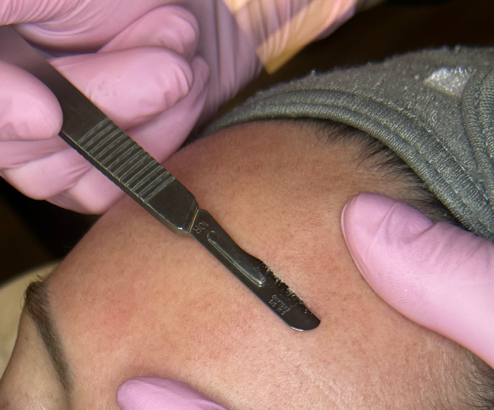 Dermaplane Add On