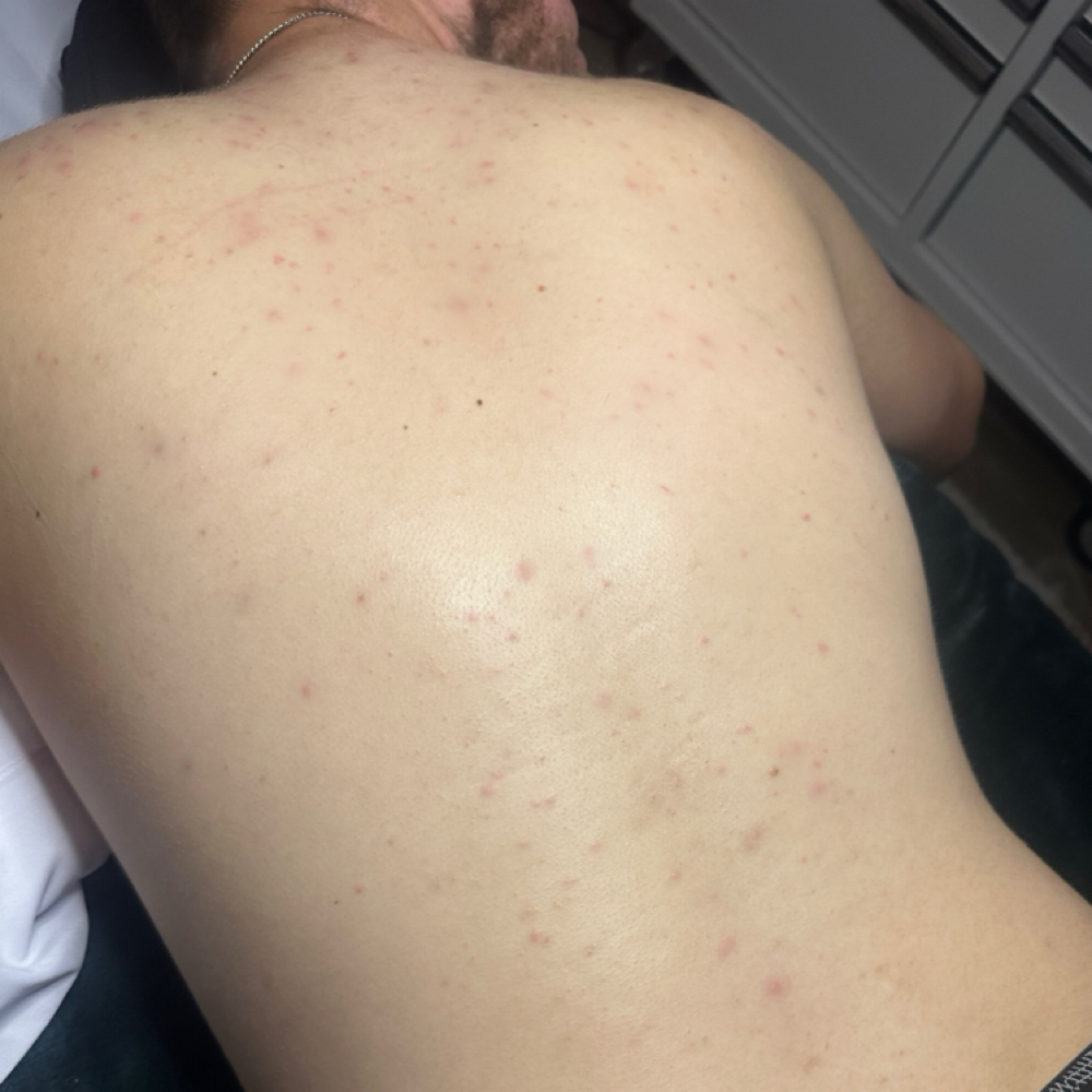 Clarifying Back Facial at Bella Christine’s Spa in Jefferson, OH
