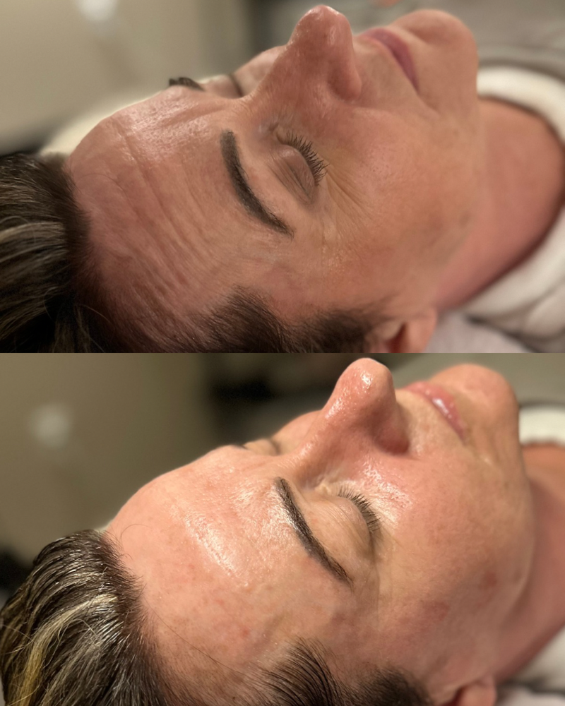 “Botox In A Bottle” Facial