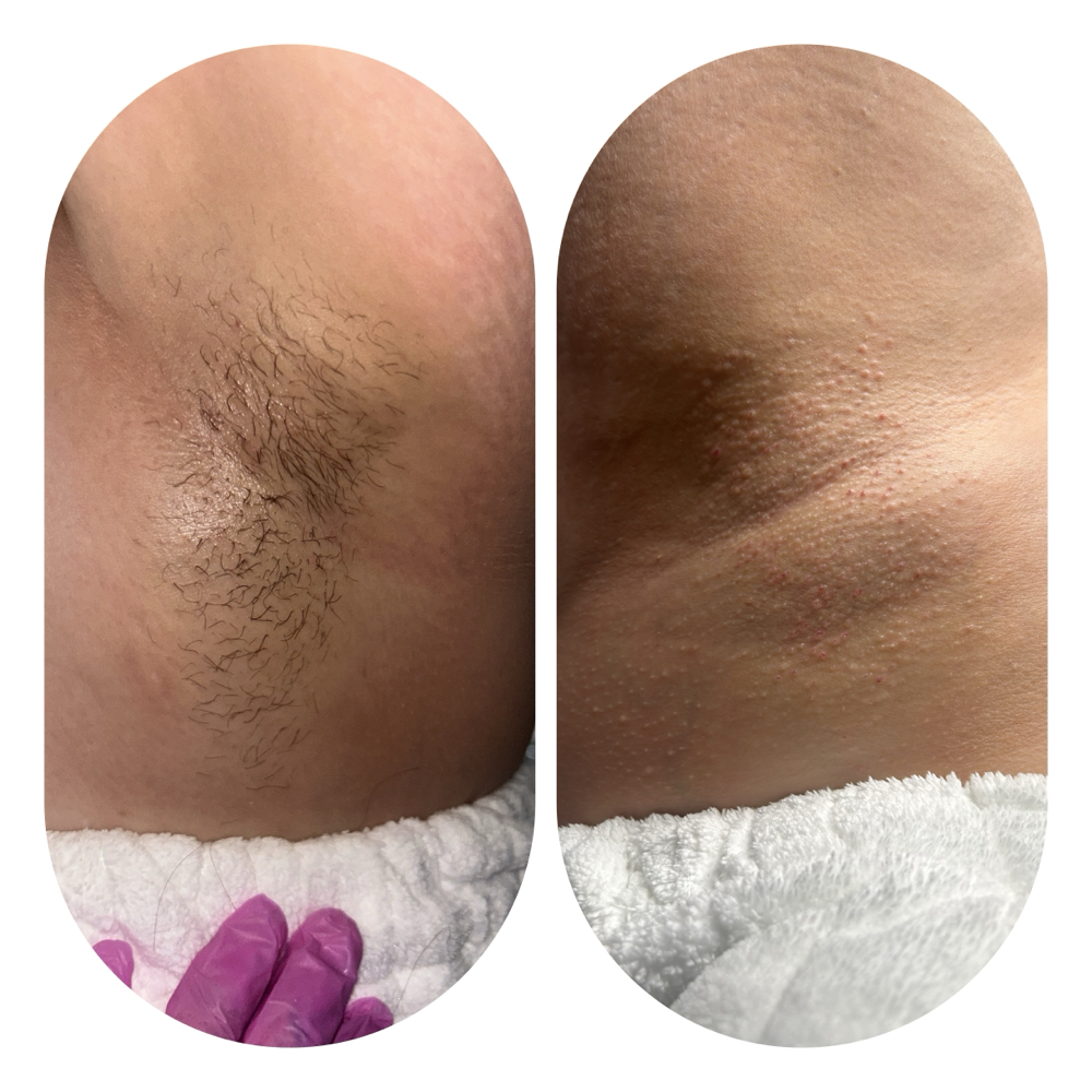 Underarm Wax