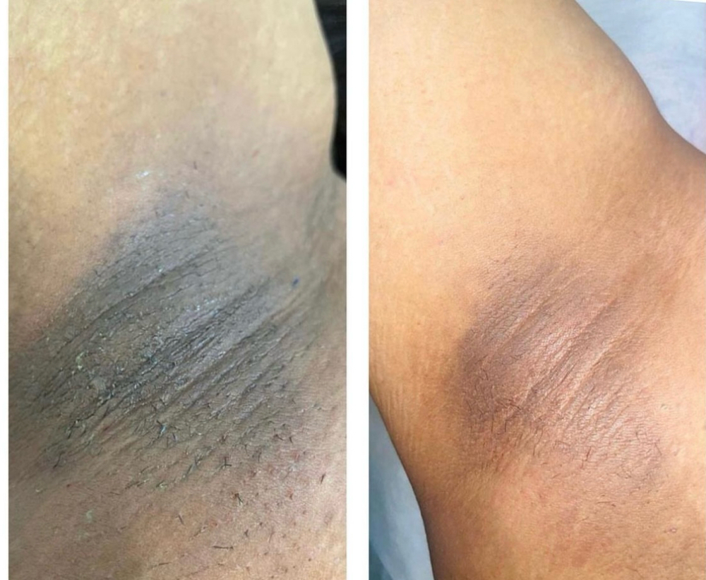 Bryghten Up (skin Bleaching)