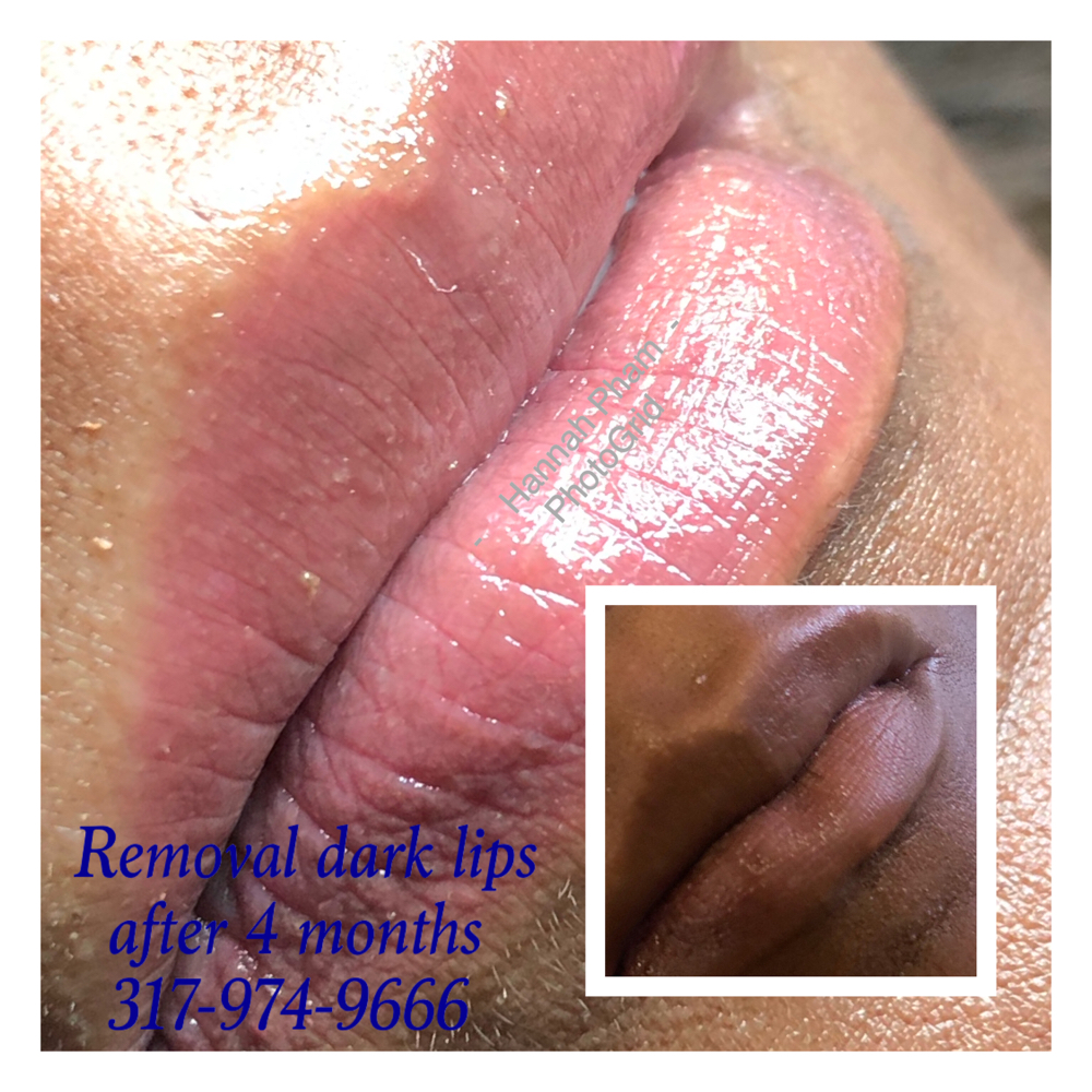 Dark Lips Removal