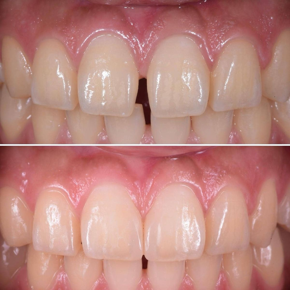 Gap Closure