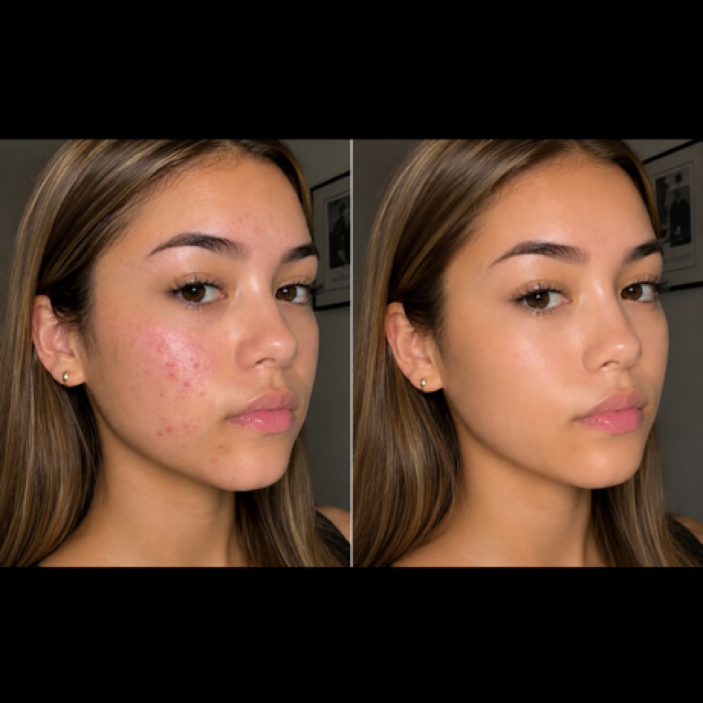 ZEMITS TEEN FACIAL at ELEVATED SKIN in Dallas, TX
