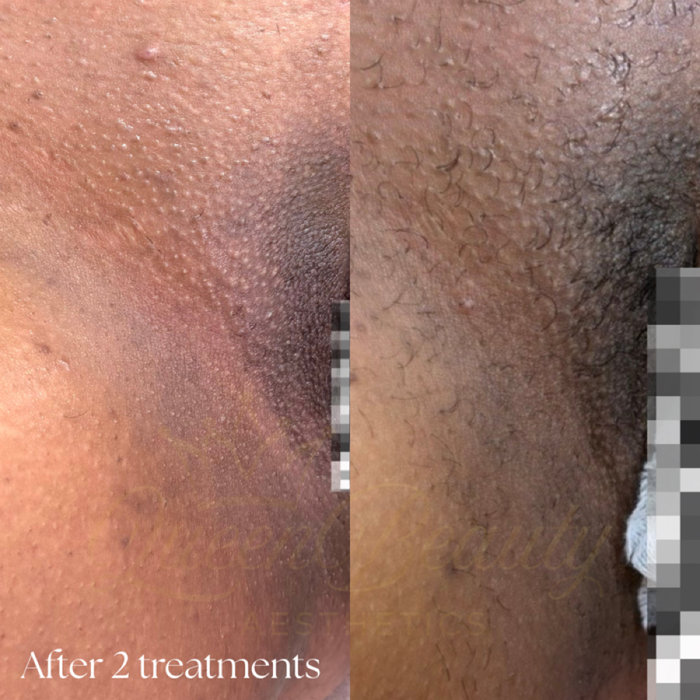 Intimate Brightening Treatments ✨ at QueenBeautyAesthetics LLC in White Plains, NY