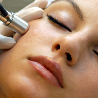 Microdermabrasion Treatment at GLOW Skin Studio in SONOMA, CA