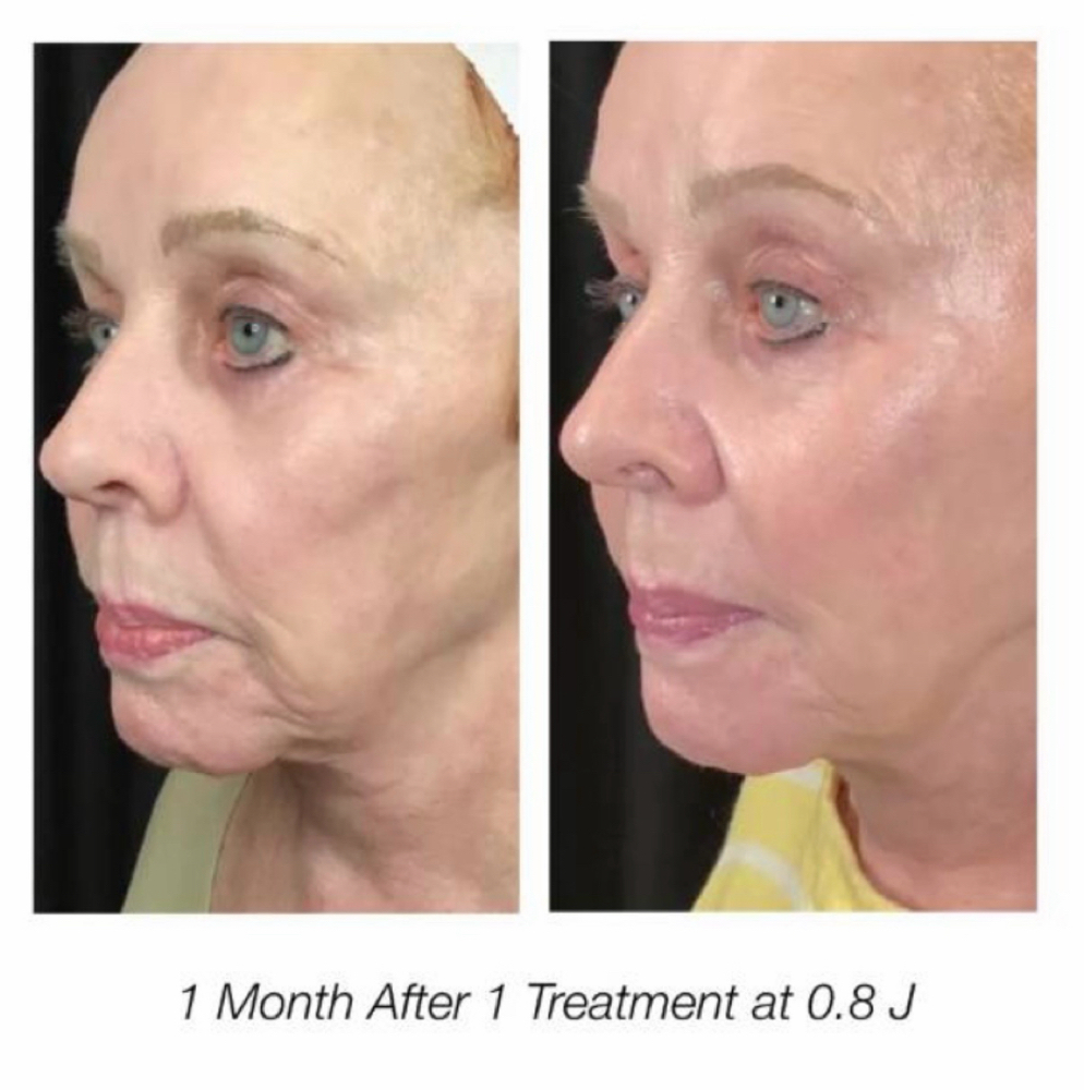 NeoGen 3 Month Protocol at Rustic Roots Aesthetics in Trinity, FL