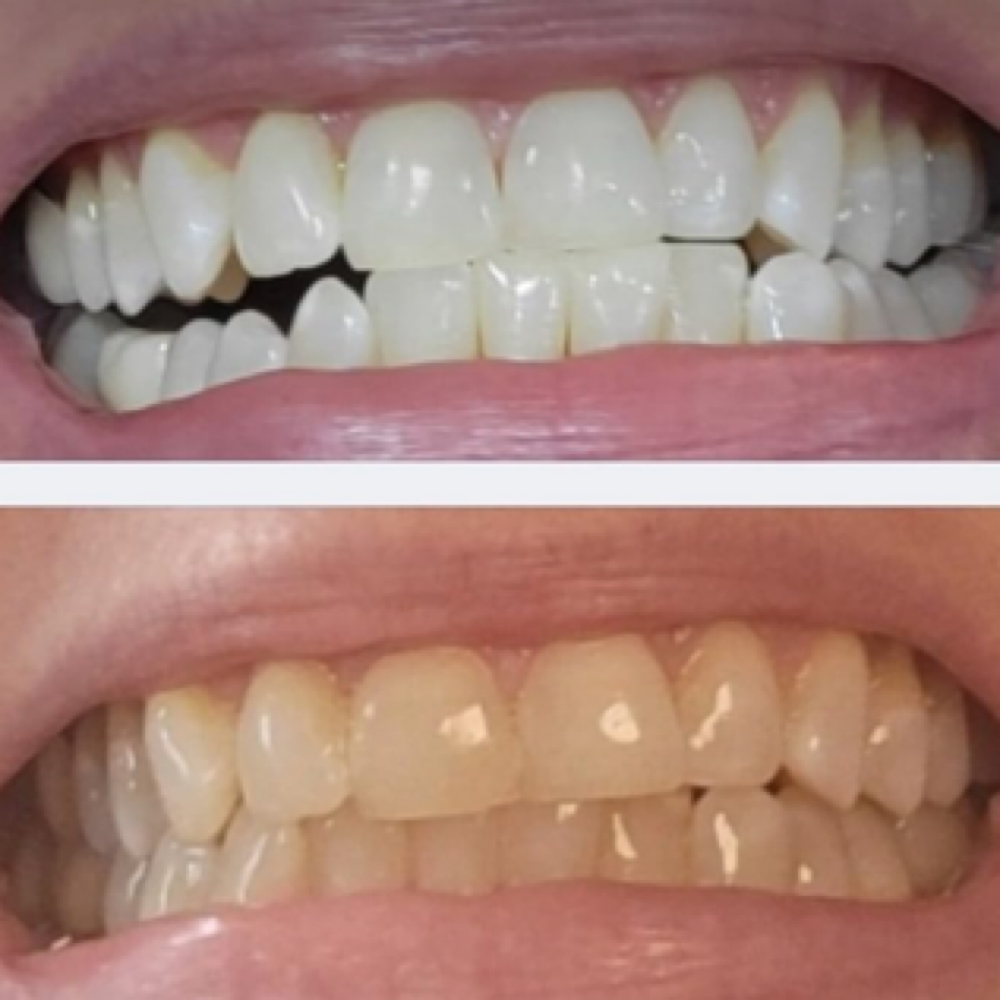 Teeth Whitening Service - Jay at Heartbreak Nail Club in Asheville, NC