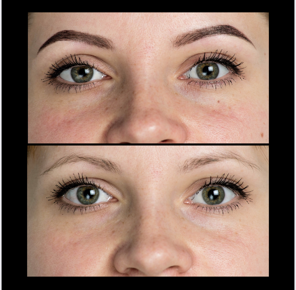 Saline PMU Removal (F/UP)