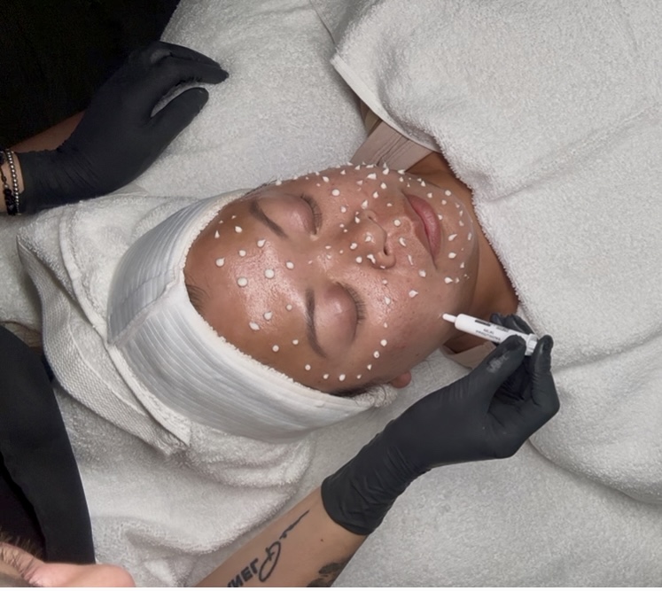 Cell Story-Liquid Microneedling