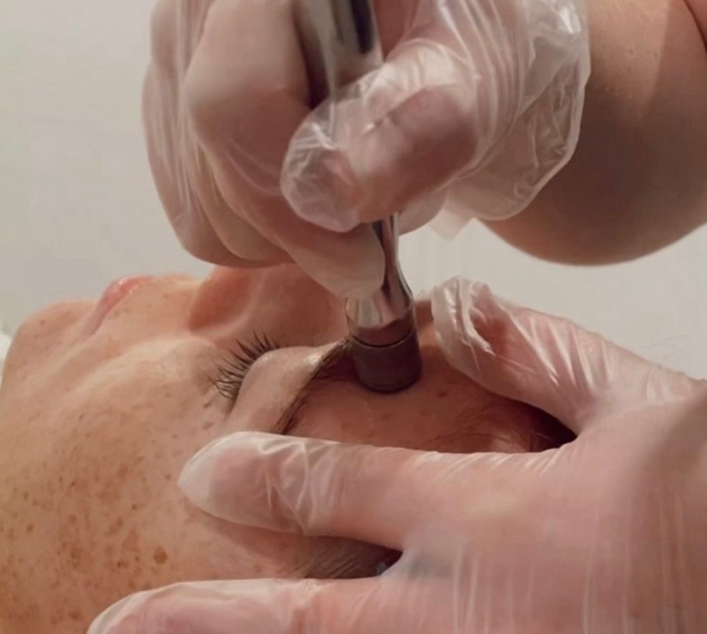Microderm Facial