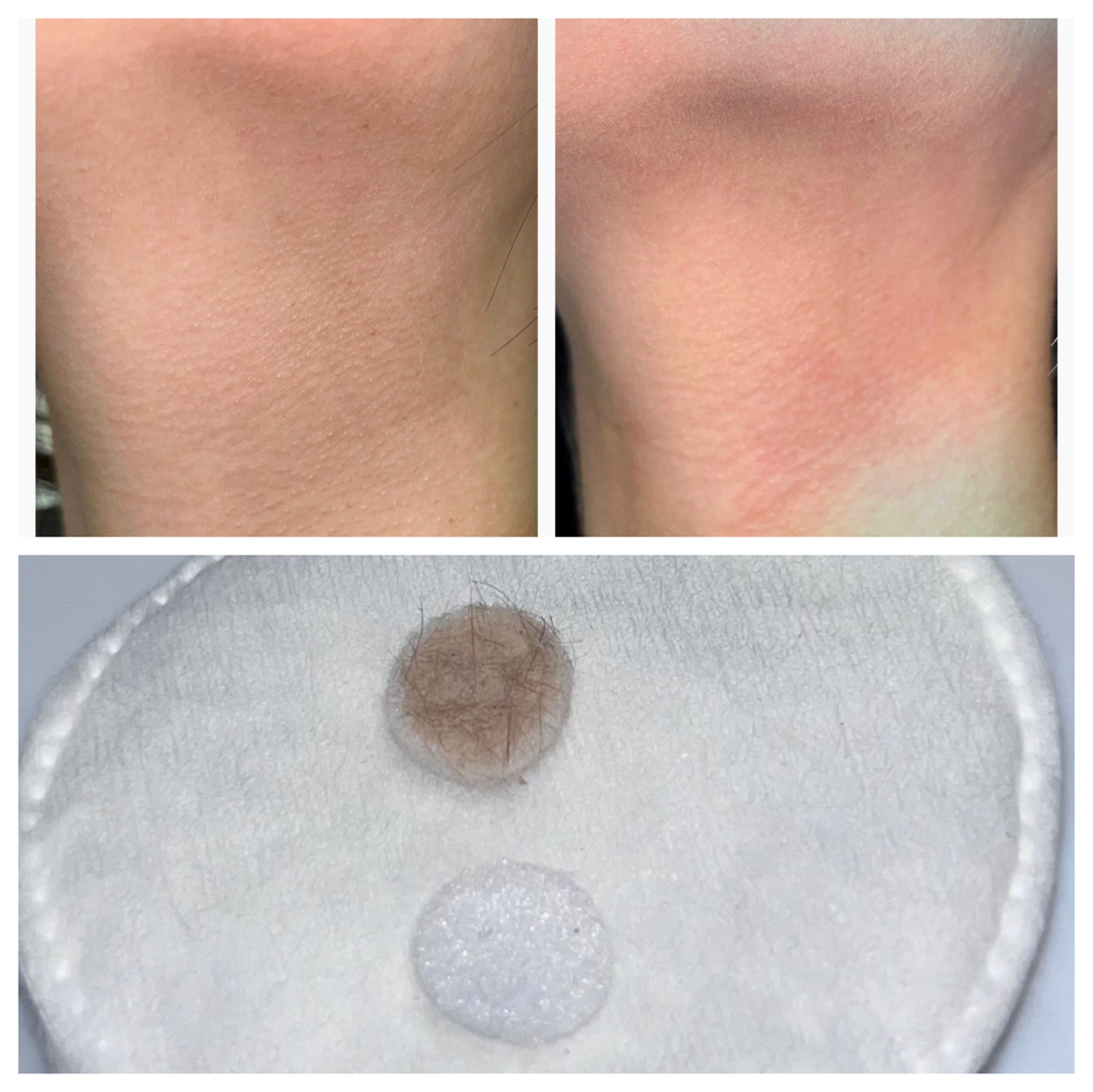 Microdermabrasion (add on)