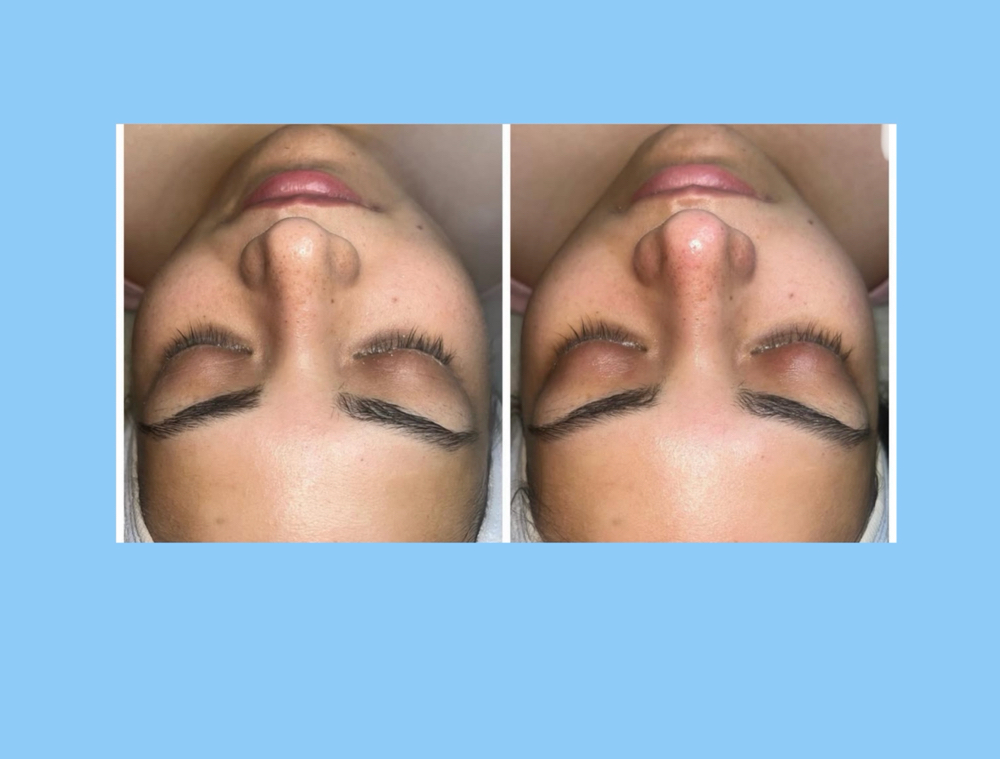 Full Signature Facial at Kohinoor Aesthetics By Marissa Elizabeth in San Antonio, TX
